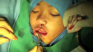 Observe a cleft-lip surgery performed by doctors of the International Children's Surgical Foundation